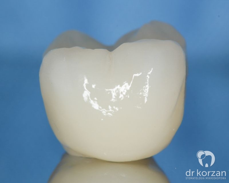 Implanty zębowe - 