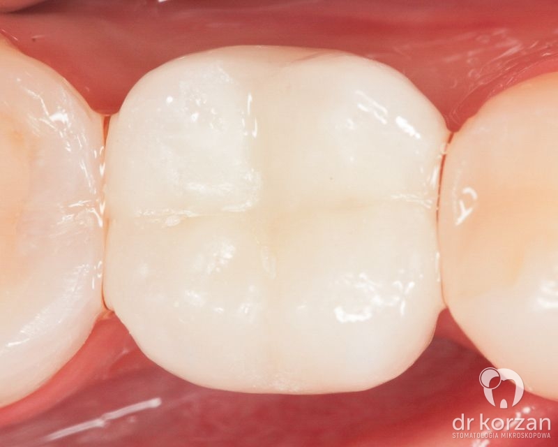 Implanty zębowe - 