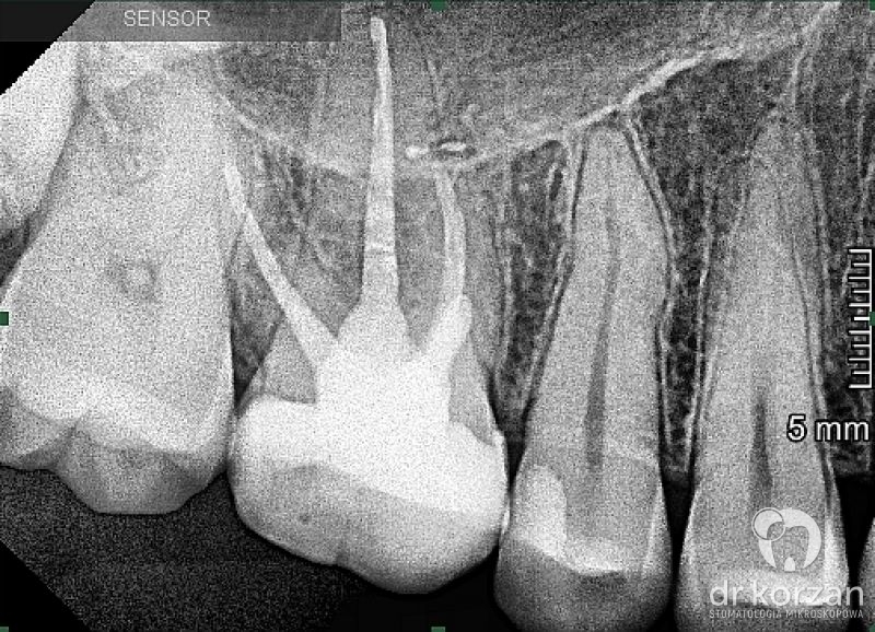 Leczenie kanałowe - Zdjęcie kontrolne po wypełnieniu kanałów